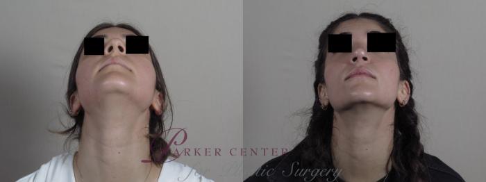 Rhinoplasty Case 1224 Before & After View #3 | Paramus, NJ | Parker Center for Plastic Surgery
