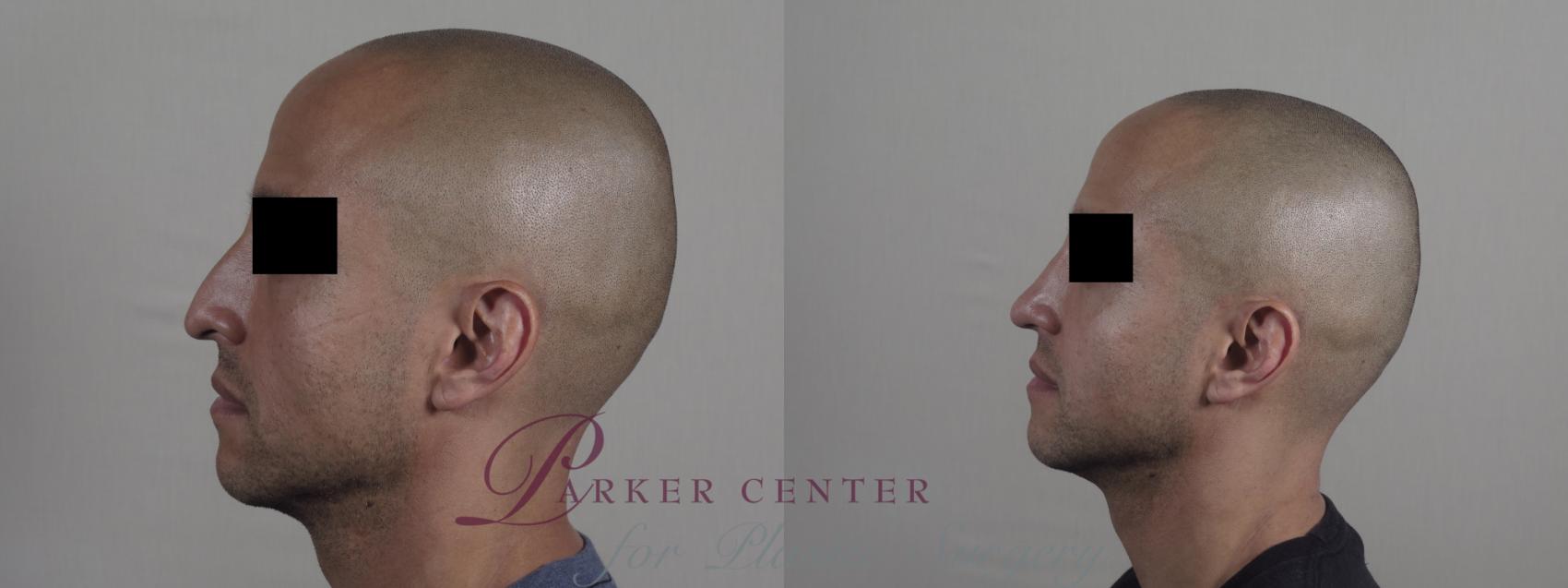 Rhinoplasty Case 1227 Before & After View #1  | Paramus, NJ | Parker Center for Plastic Surgery
