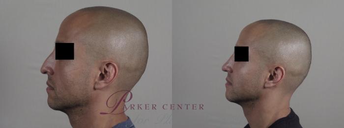Rhinoplasty Case 1227 Before & After View #1  | Paramus, New Jersey | Parker Center for Plastic Surgery