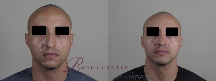 Rhinoplasty Case 1227 Before & After View #2 | Paramus, NJ | Parker Center for Plastic Surgery