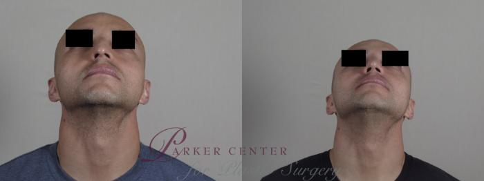Rhinoplasty Case 1227 Before & After View #3 | Paramus, NJ | Parker Center for Plastic Surgery