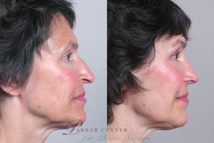 Rhinoplasty Case 123 Before & After View #2 | Paramus, NJ | Parker Center for Plastic Surgery