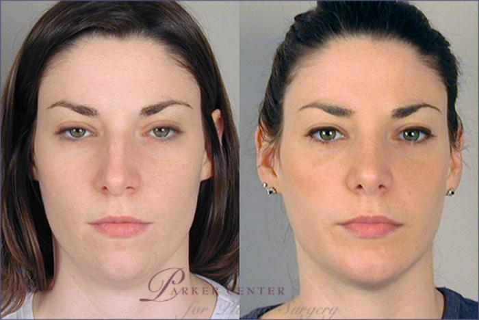 Rhinoplasty Case 124 Before & After View #1 | Paramus, NJ | Parker Center for Plastic Surgery