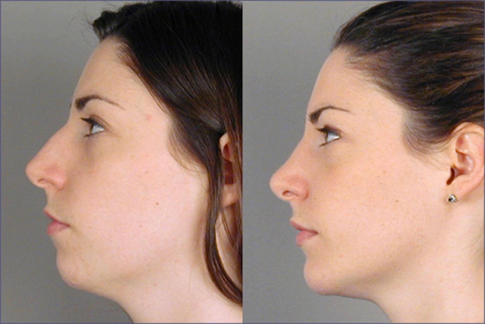 Rhinoplasty Case 124 Before & After View #2 | Paramus, New Jersey | Parker Center for Plastic Surgery