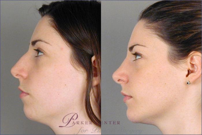 Rhinoplasty Case 124 Before & After View #2 | Paramus, NJ | Parker Center for Plastic Surgery
