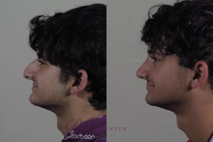 Rhinoplasty Case 1253 Before & After Left Side | Paramus, New Jersey | Parker Center for Plastic Surgery