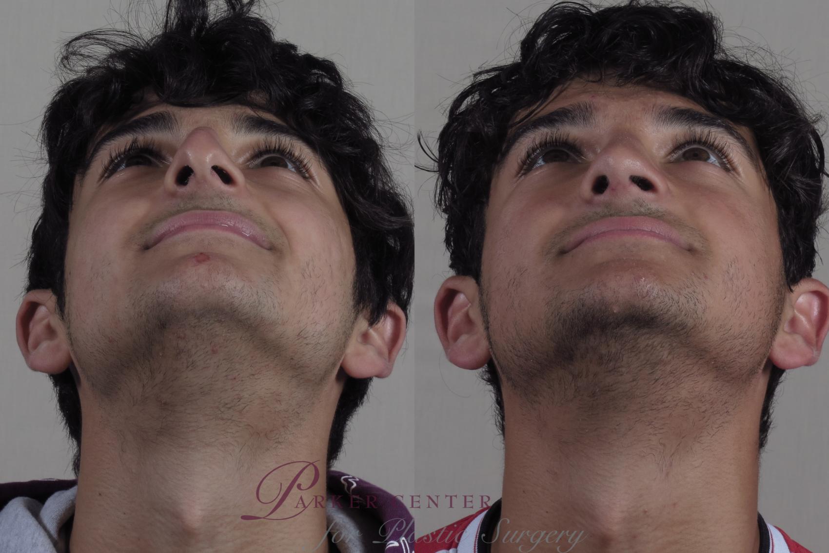 Rhinoplasty Case 1253 Before & After Worns View  | Paramus, NJ | Parker Center for Plastic Surgery