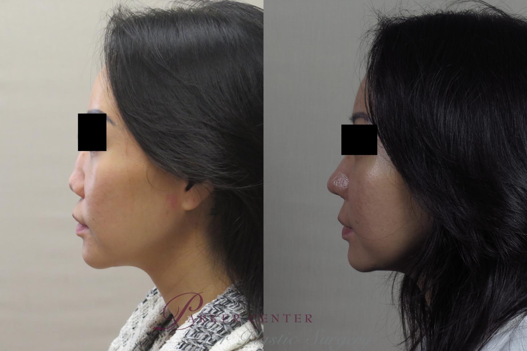Rhinoplasty Case 1254 Before & After Left Side | Paramus, NJ | Parker Center for Plastic Surgery