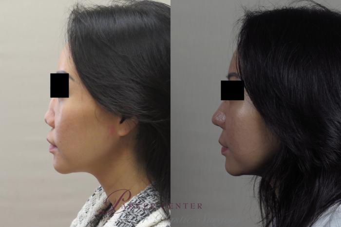 Rhinoplasty Case 1254 Before & After Left Side | Paramus, NJ | Parker Center for Plastic Surgery