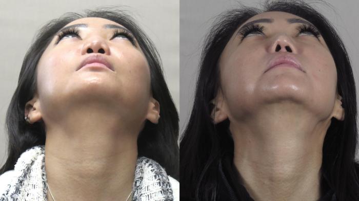 Rhinoplasty Case 1254 Before & After Worm's | Paramus, New Jersey | Parker Center for Plastic Surgery