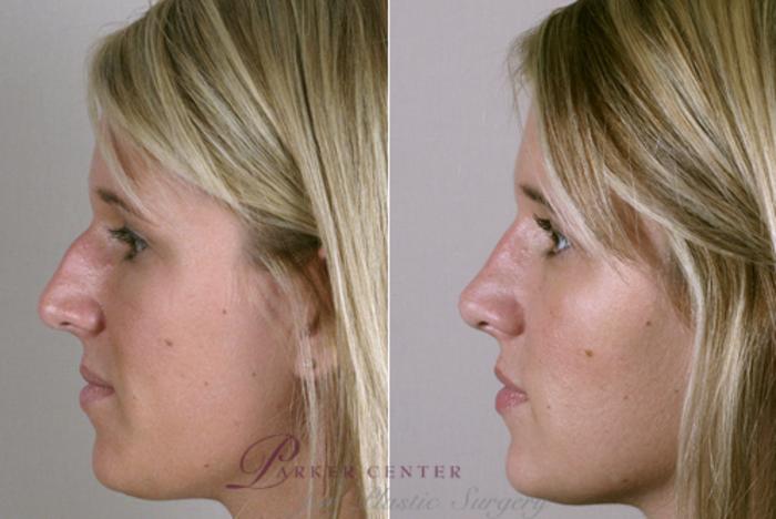 Rhinoplasty Case 126 Before & After View #2 | Paramus, NJ | Parker Center for Plastic Surgery