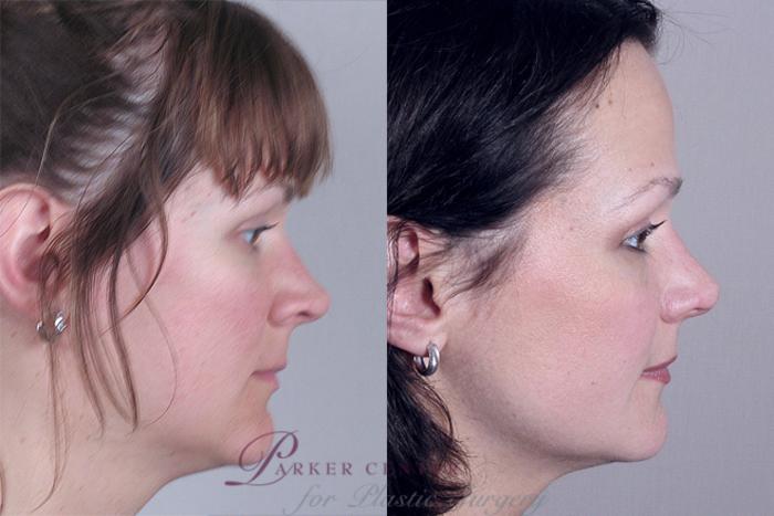 Rhinoplasty Case 127 Before & After View #2 | Paramus, NJ | Parker Center for Plastic Surgery