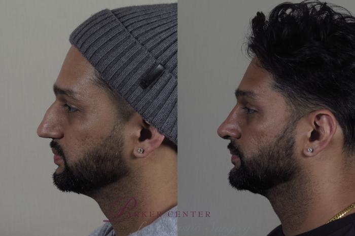 Rhinoplasty Case 1270 Before & After Left Side | Paramus, NJ | Parker Center for Plastic Surgery
