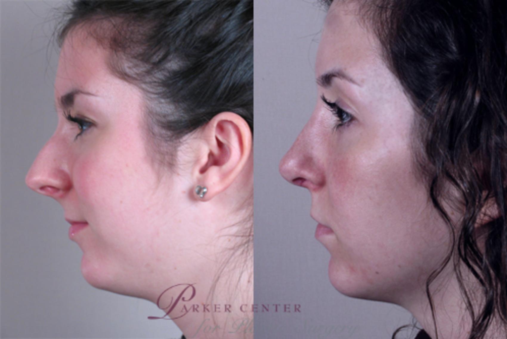 Rhinoplasty Case 128 Before & After View #2 | Paramus, NJ | Parker Center for Plastic Surgery