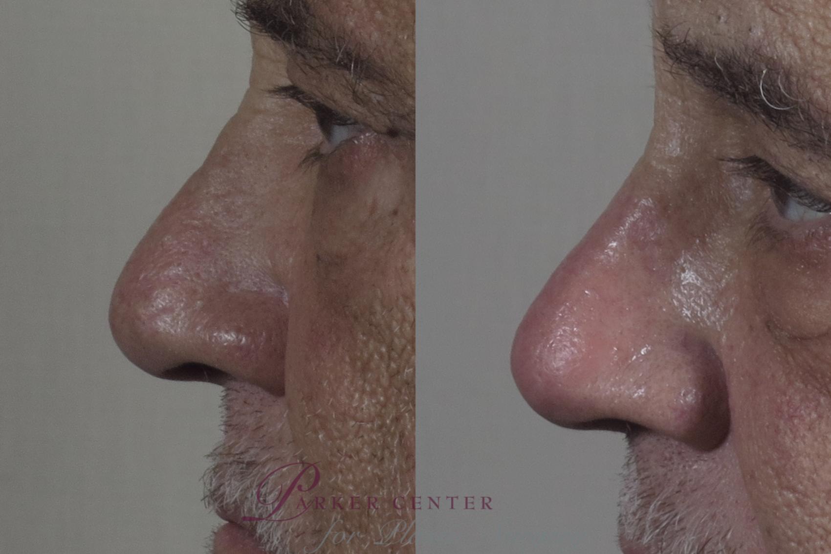Rhinoplasty Case 1289 Before & After Left Side | Paramus, NJ | Parker Center for Plastic Surgery