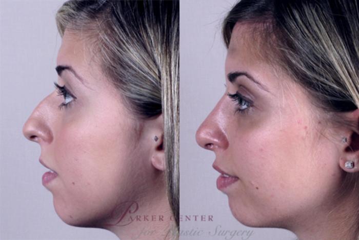 Rhinoplasty Case 129 Before & After View #2 | Paramus, NJ | Parker Center for Plastic Surgery