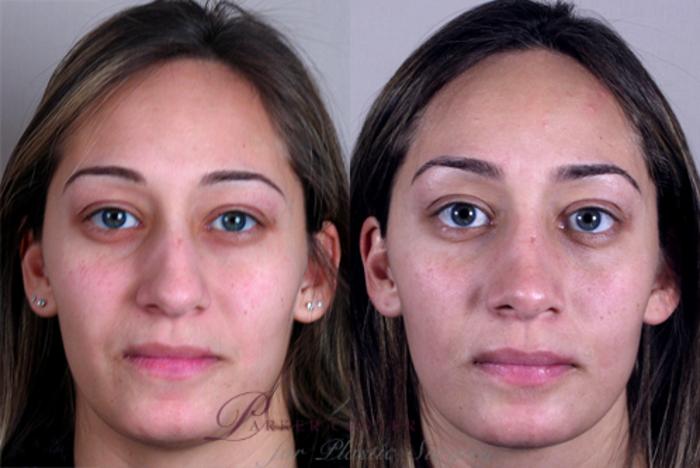 Rhinoplasty Case 130 Before & After View #1 | Paramus, NJ | Parker Center for Plastic Surgery