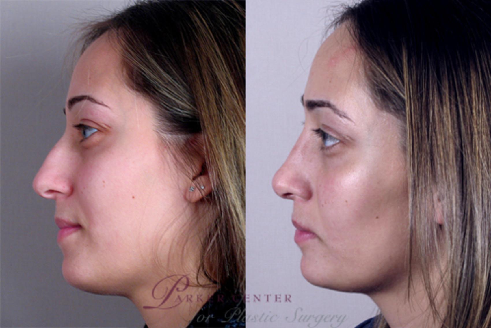Rhinoplasty Case 130 Before & After View #2 | Paramus, NJ | Parker Center for Plastic Surgery