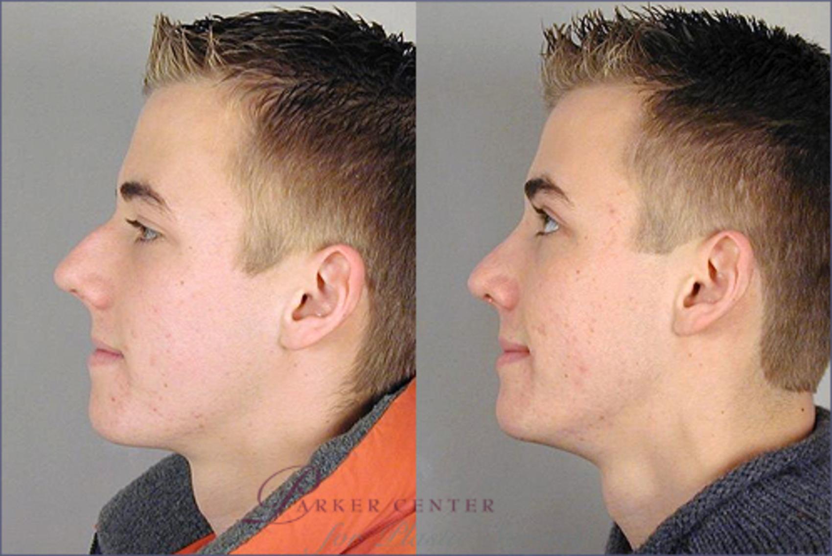 Rhinoplasty Case 131 Before & After View #2 | Paramus, NJ | Parker Center for Plastic Surgery