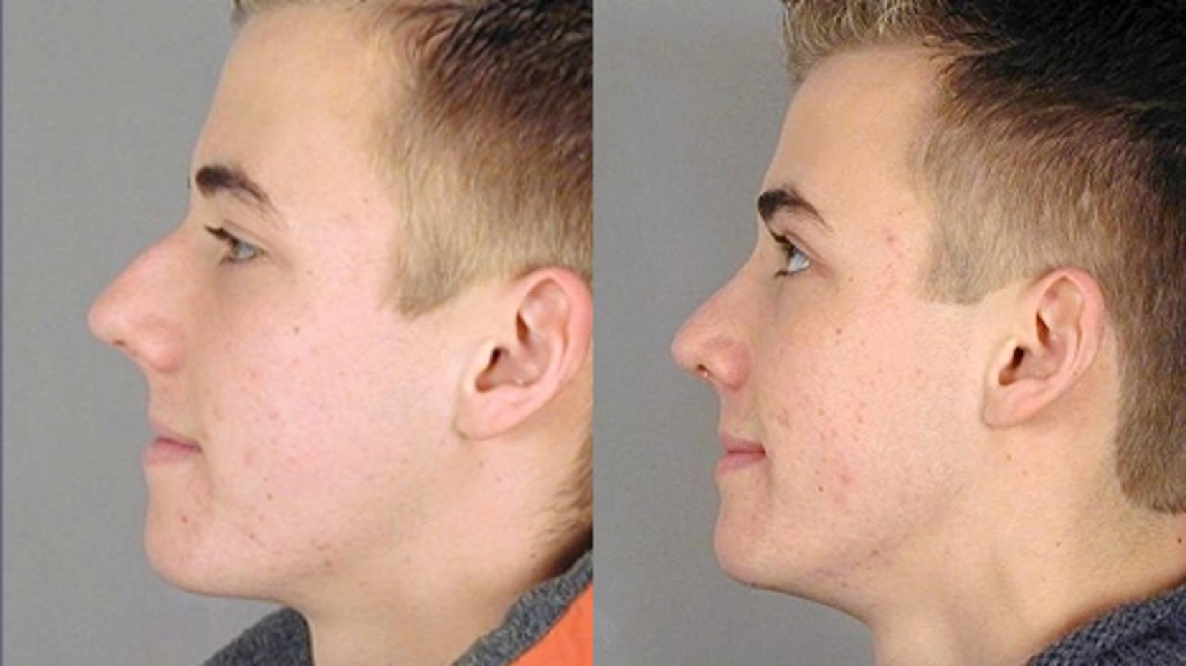 Rhinoplasty Case 131 Before & After View #2 | Paramus, NJ | Parker Center for Plastic Surgery