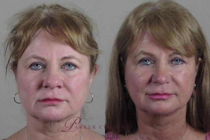 Rhinoplasty Case 1323 Before & After Front | Paramus, NJ | Parker Center for Plastic Surgery