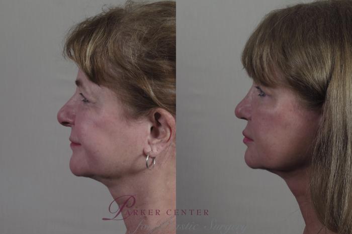 Rhinoplasty Case 1323 Before & After Left Side | Paramus, NJ | Parker Center for Plastic Surgery