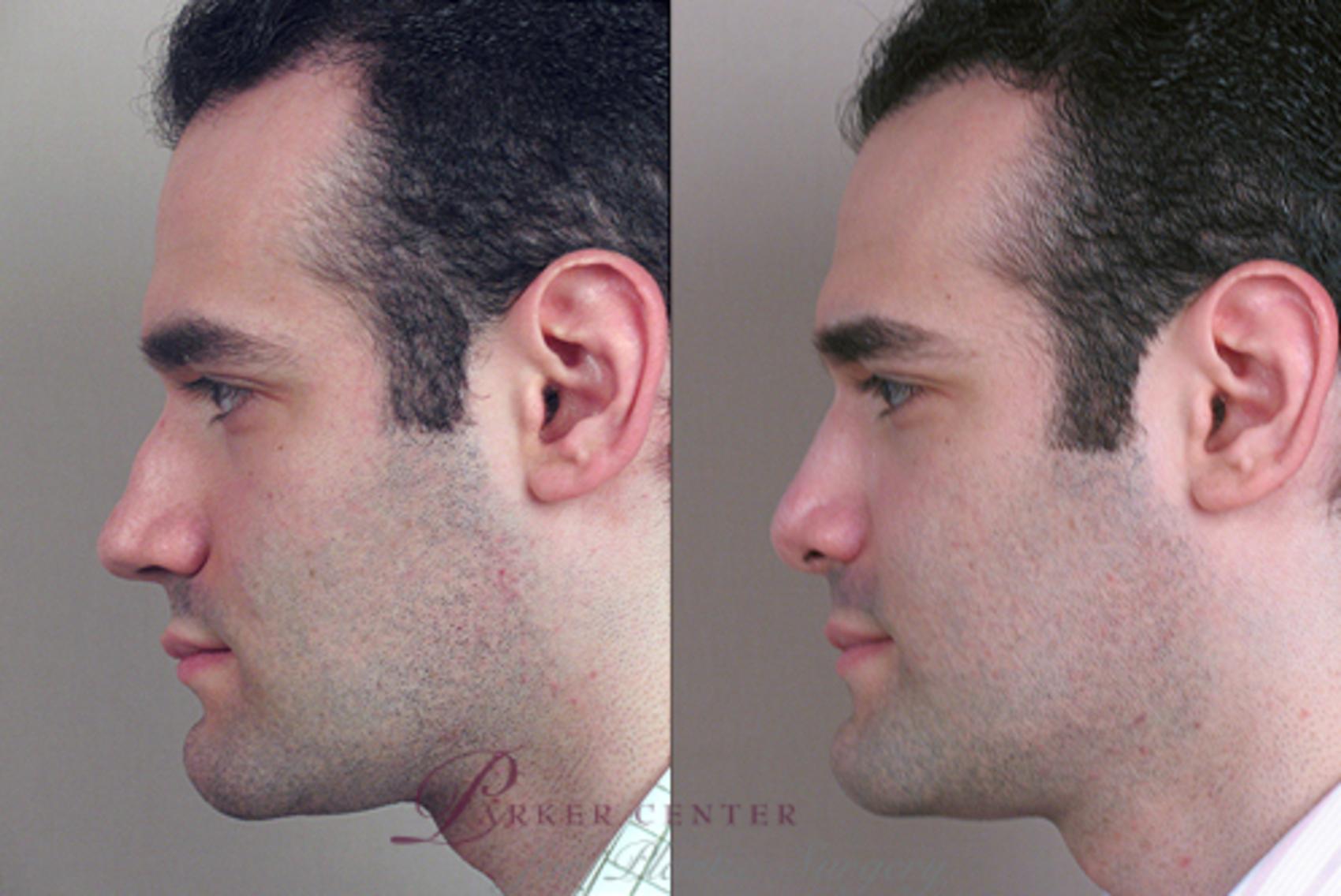 Rhinoplasty Case 133 Before & After View #2 | Paramus, NJ | Parker Center for Plastic Surgery