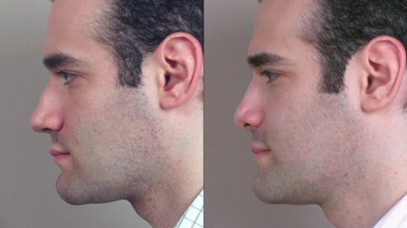 Rhinoplasty Case 133 Before & After View #2 | Paramus, NJ | Parker Center for Plastic Surgery