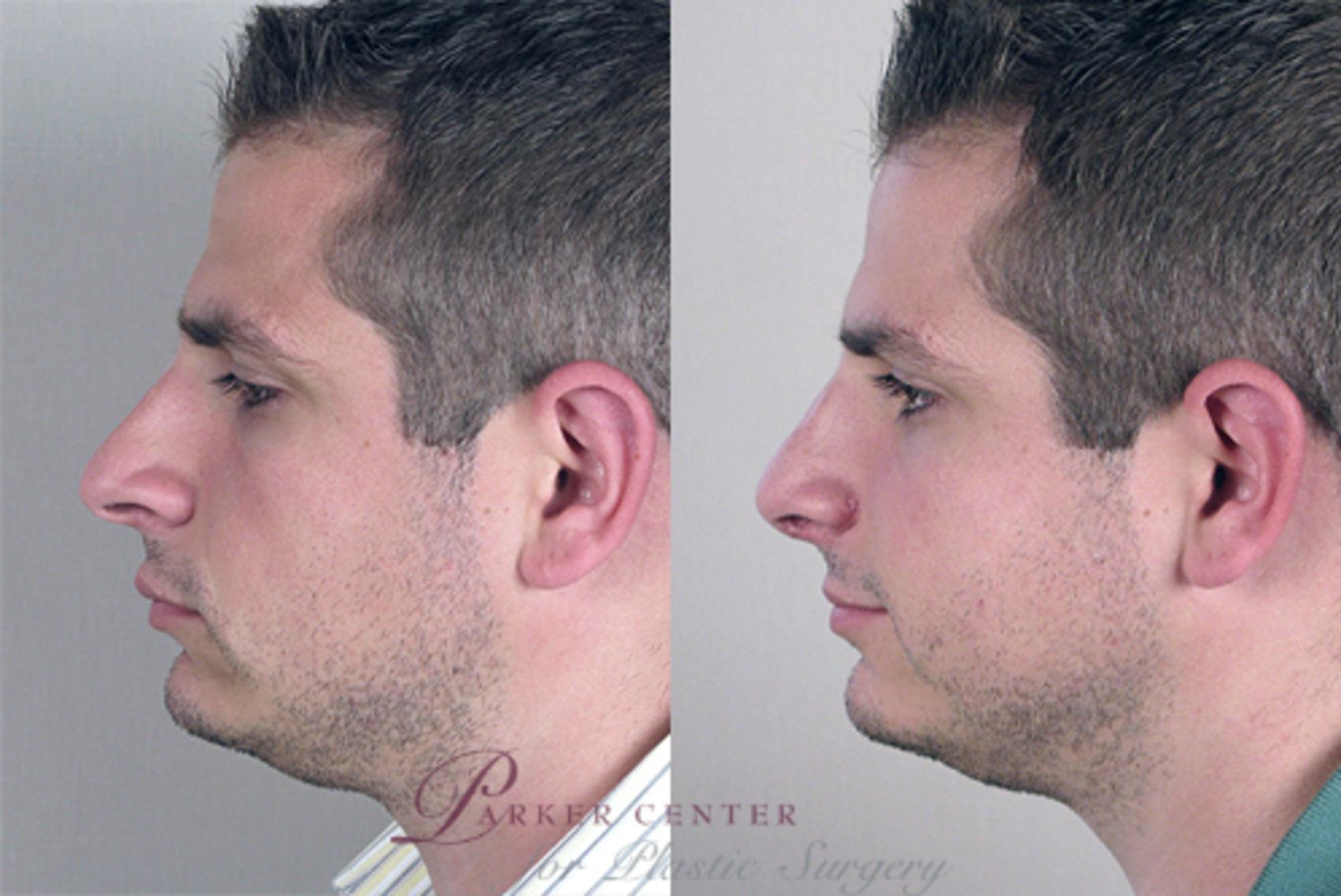Rhinoplasty Case 134 Before & After View #2 | Paramus, NJ | Parker Center for Plastic Surgery