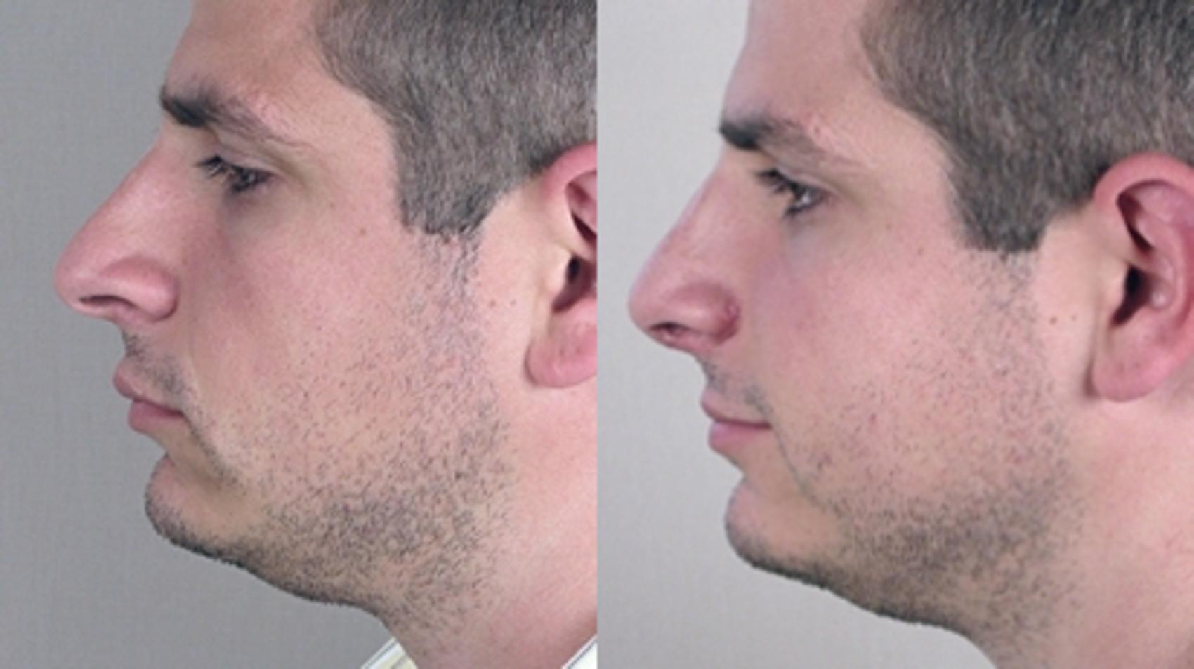 Rhinoplasty Case 134 Before & After View #2 | Paramus, NJ | Parker Center for Plastic Surgery