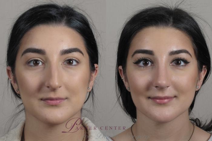 Rhinoplasty Case 1341 Before & After Front | Paramus, NJ | Parker Center for Plastic Surgery