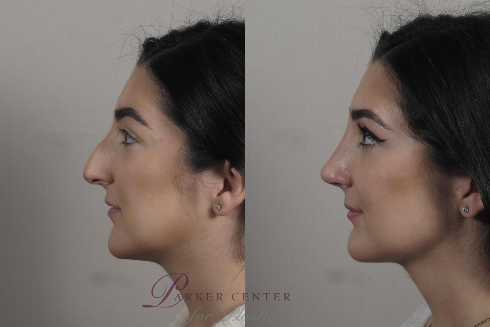 Rhinoplasty Case 1341 Before & After Left Side | Paramus, NJ | Parker Center for Plastic Surgery