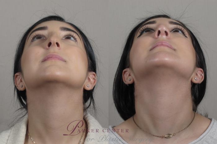 Rhinoplasty Case 1341 Before & After Worns View  | Paramus, NJ | Parker Center for Plastic Surgery