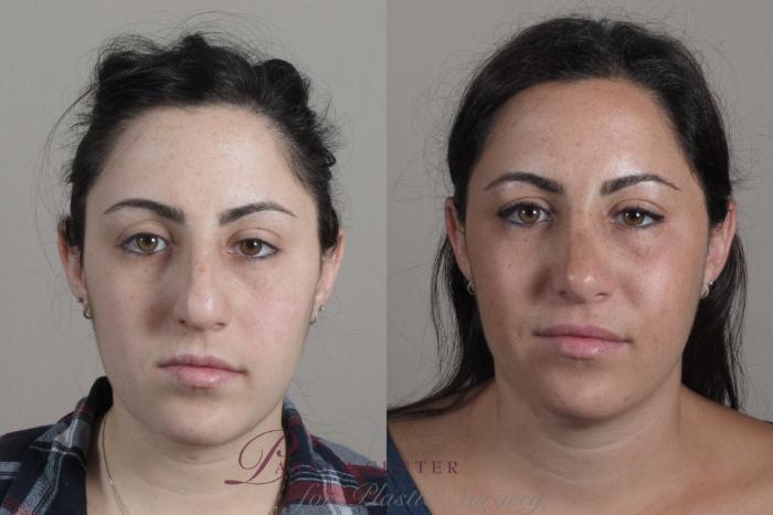 Rhinoplasty Case 1342 Before & After Front | Paramus, NJ | Parker Center for Plastic Surgery