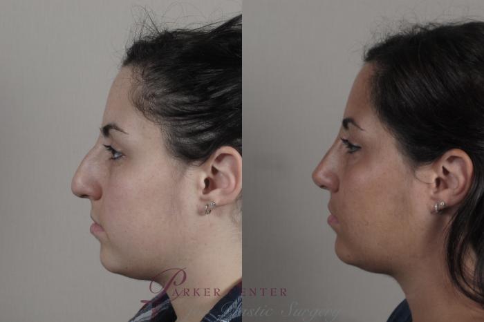 Rhinoplasty Case 1342 Before & After Left Side | Paramus, NJ | Parker Center for Plastic Surgery