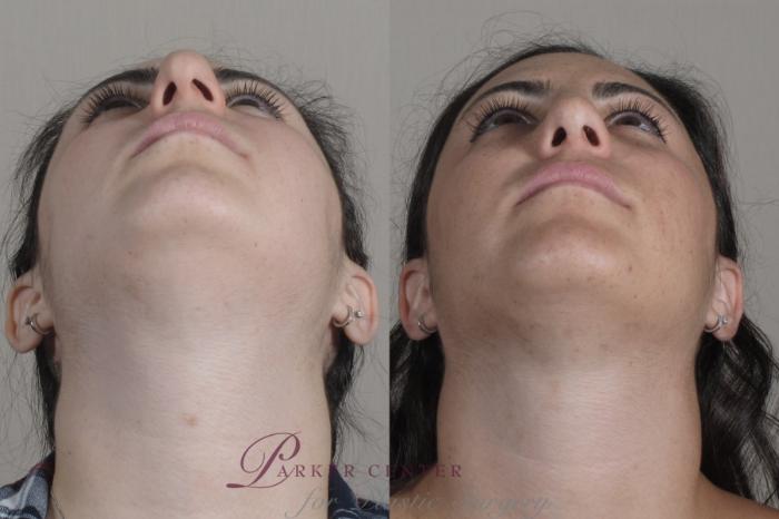 Rhinoplasty Case 1342 Before & After Worns View  | Paramus, NJ | Parker Center for Plastic Surgery