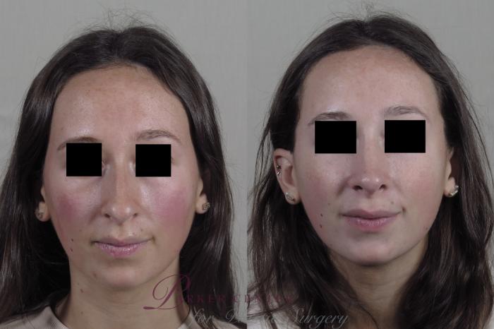 Rhinoplasty Case 1343 Before & After Front | Paramus, NJ | Parker Center for Plastic Surgery