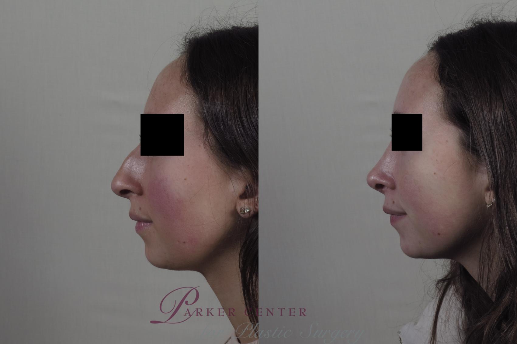 Rhinoplasty Case 1343 Before & After Left Side | Paramus, NJ | Parker Center for Plastic Surgery