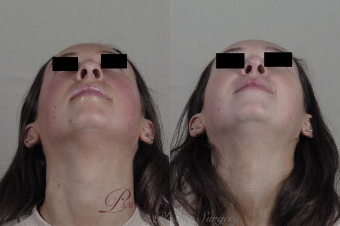 Rhinoplasty Case 1343 Before & After Worns View  | Paramus, NJ | Parker Center for Plastic Surgery