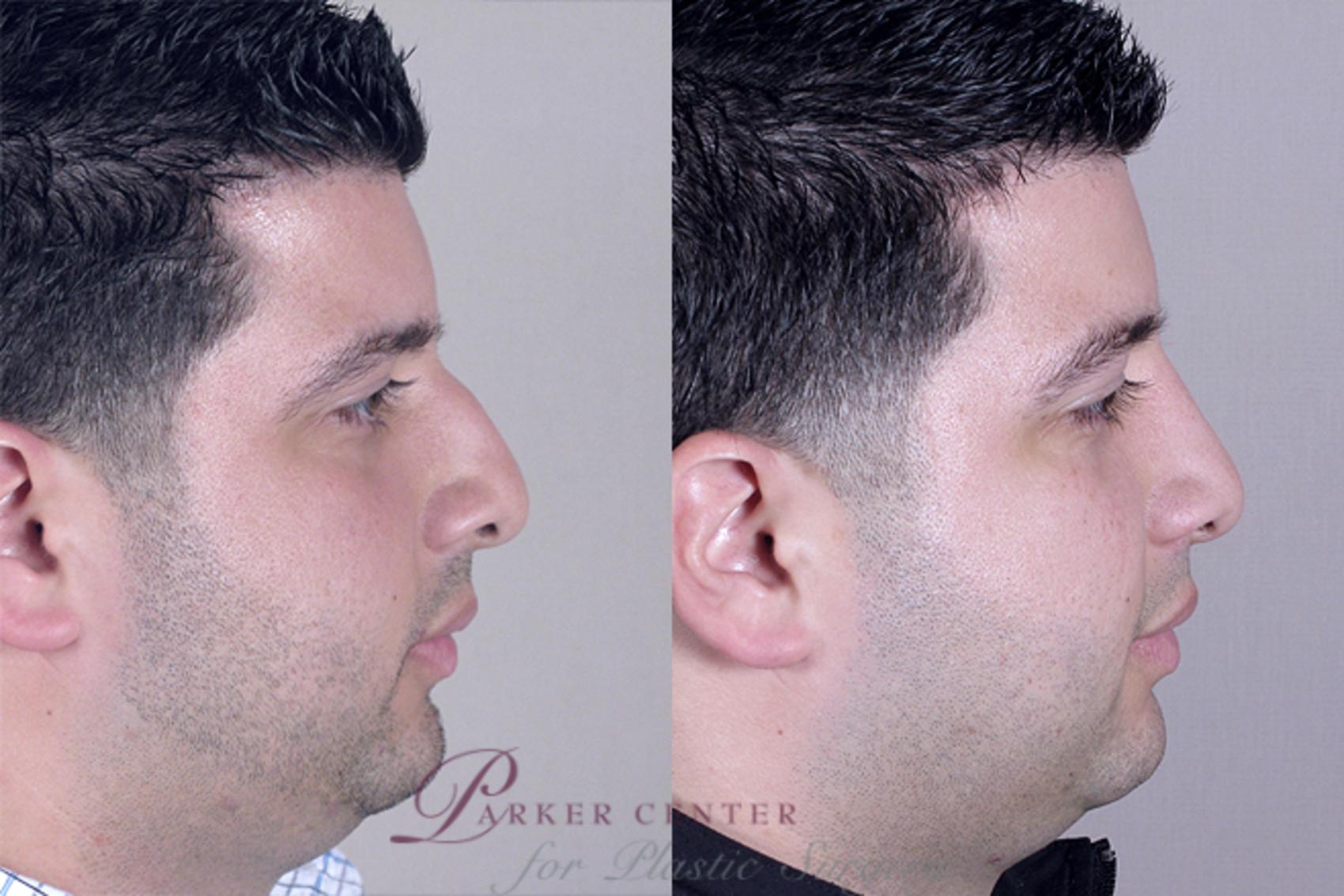 Rhinoplasty Case 135 Before & After View #2 | Paramus, NJ | Parker Center for Plastic Surgery