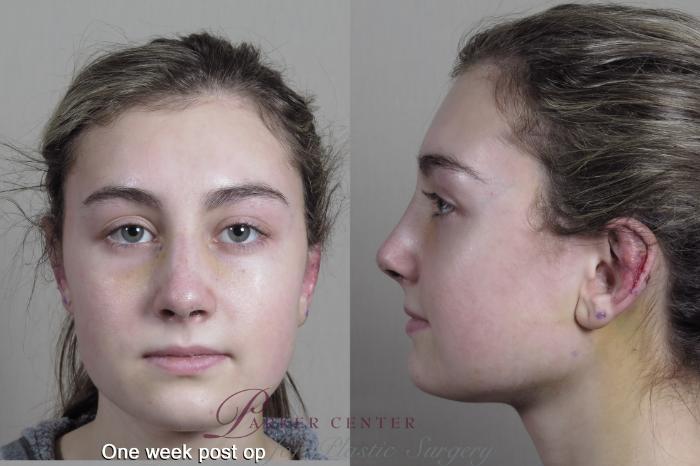 Rhinoplasty Case 1350 Before & After 1 week  | Paramus, New Jersey | Parker Center for Plastic Surgery