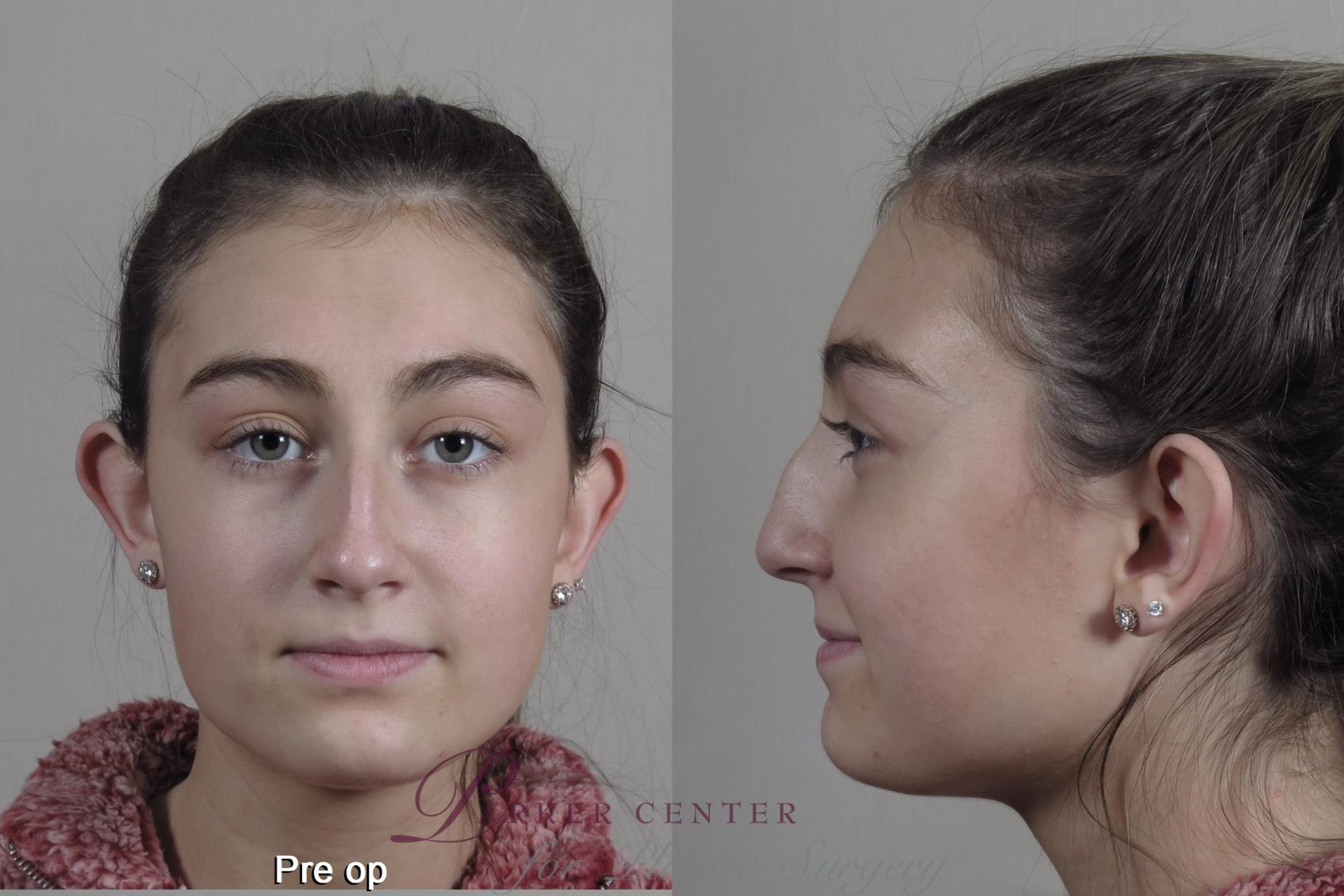 Rhinoplasty Case 1350 Before & After pre op  | Paramus, New Jersey | Parker Center for Plastic Surgery