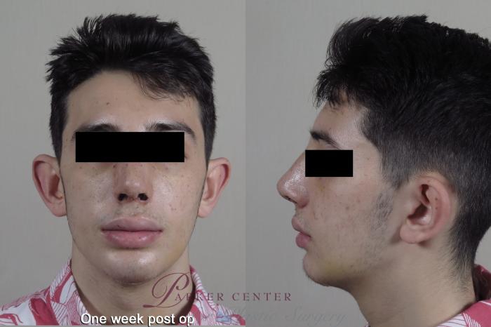 Rhinoplasty Case 1354 Before & After 1 week  | Paramus, New Jersey | Parker Center for Plastic Surgery