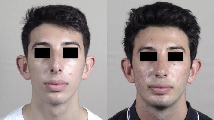 Rhinoplasty Case 1354 Before & After Front | Paramus, New Jersey | Parker Center for Plastic Surgery