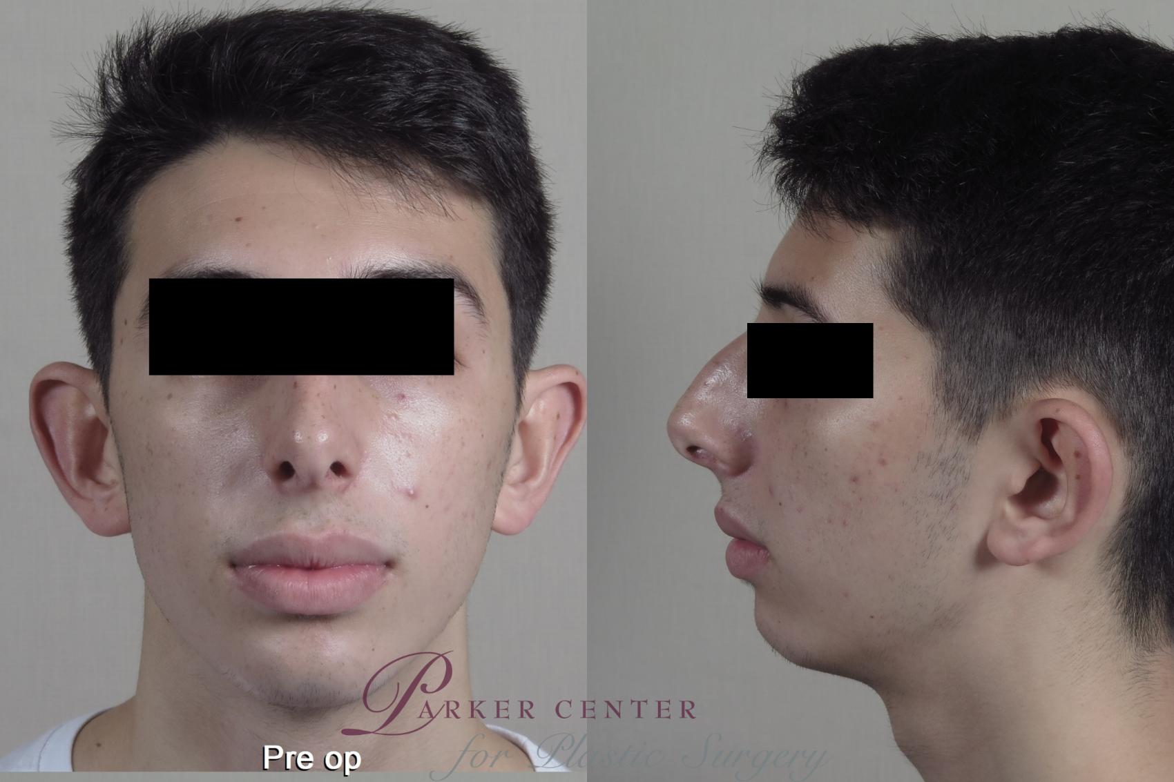 Rhinoplasty Case 1354 Before & After pre op  | Paramus, New Jersey | Parker Center for Plastic Surgery