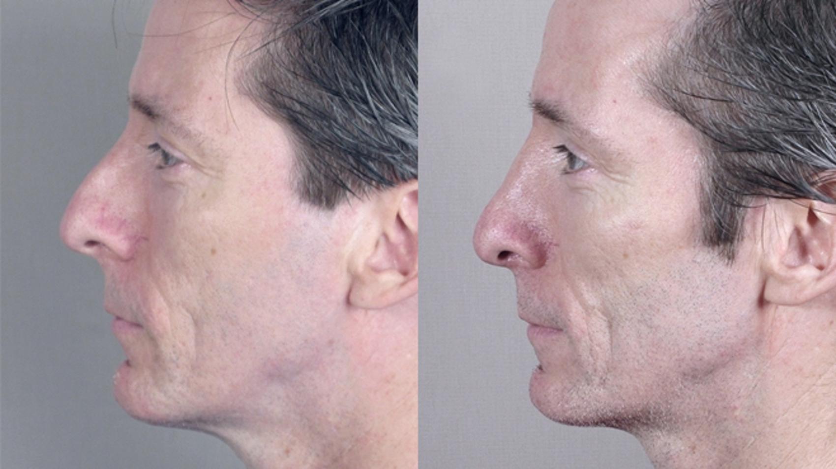 Rhinoplasty Case 136 Before & After View #2 | Paramus, NJ | Parker Center for Plastic Surgery