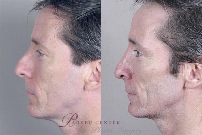 Rhinoplasty Case 136 Before & After View #2 | Paramus, NJ | Parker Center for Plastic Surgery