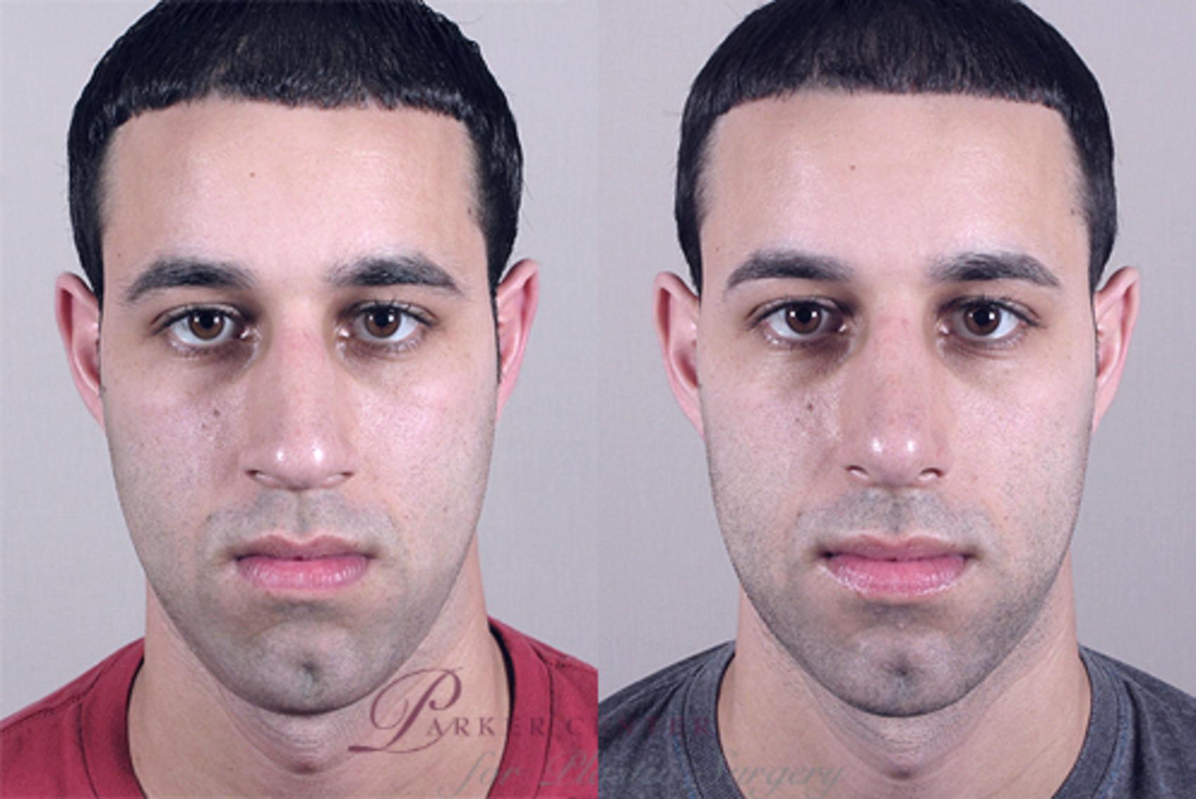 Rhinoplasty Case 137 Before & After View #1 | Paramus, NJ | Parker Center for Plastic Surgery