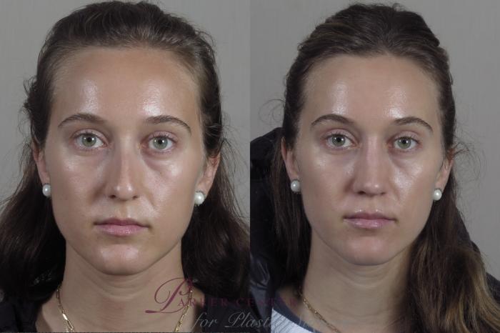 Rhinoplasty Case 1373 Before & After Front | Paramus, NJ | Parker Center for Plastic Surgery