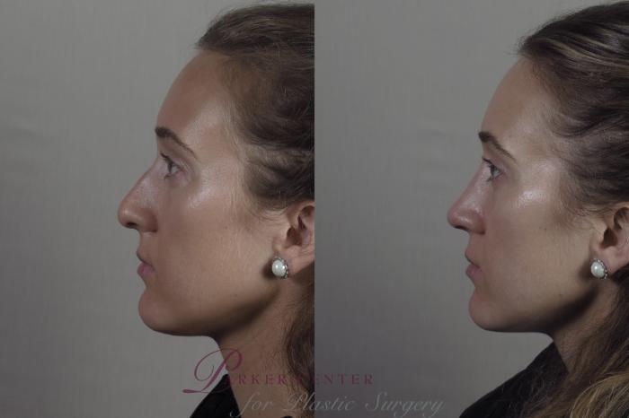 Rhinoplasty Case 1373 Before & After Left Side | Paramus, NJ | Parker Center for Plastic Surgery